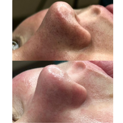 CleanSkin Pro -Limpiador Facial Ultrasónico Inalámbrico 3 en 1