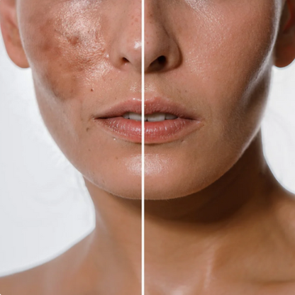 Jabón Facial de Cúrcuma Aclarante 2x1   - Despídete del Acné y las Manchas desde el Primer Uso