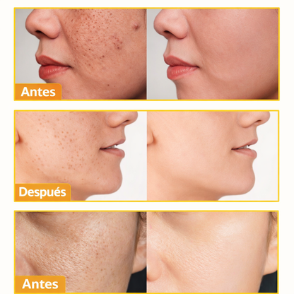 Jabón Facial de Cúrcuma Aclarante 2x1   - Despídete del Acné y las Manchas desde el Primer Uso